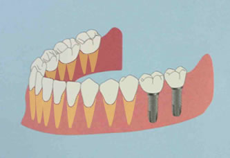 インプラント４　名護　歯科