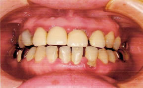 名護市の歯科　歯周病治療　症例１