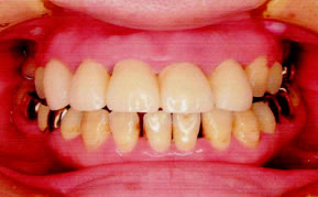 名護の歯科　症例１-b