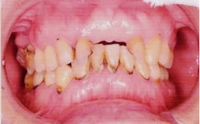 名護のながた歯科で歯周病治療３